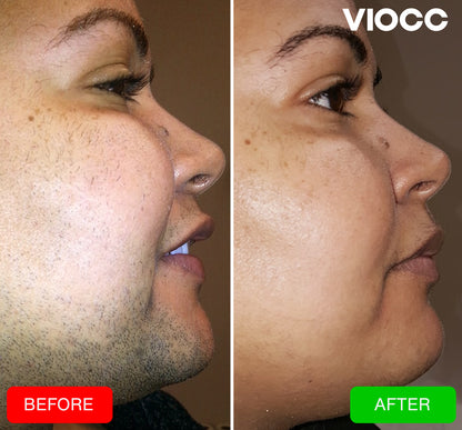 VIOCC™ Amethyst Ice IPL Laser Hair Removal Device