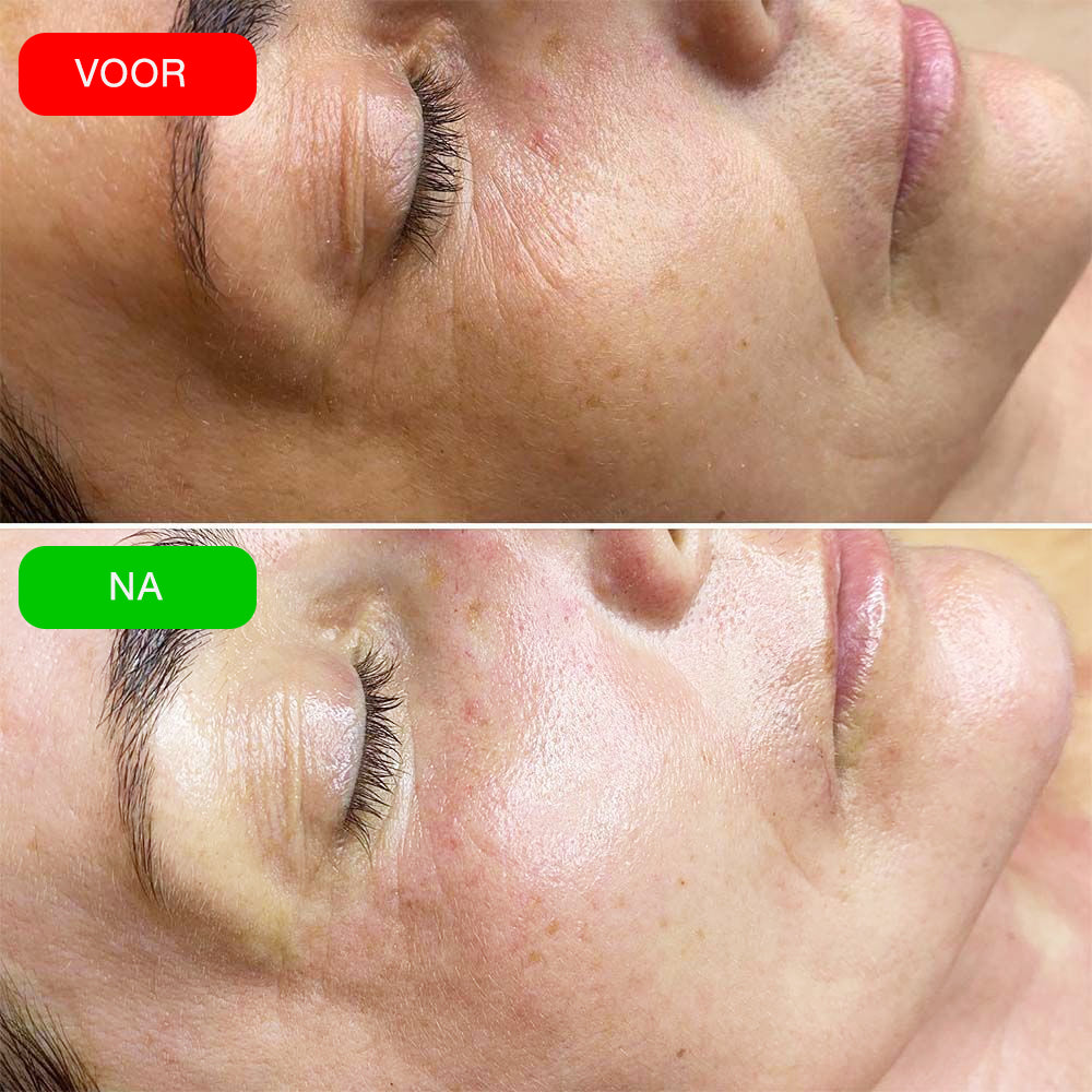 VIOCC™ Bio-Collageen Echt Diep Masker (Dutch)