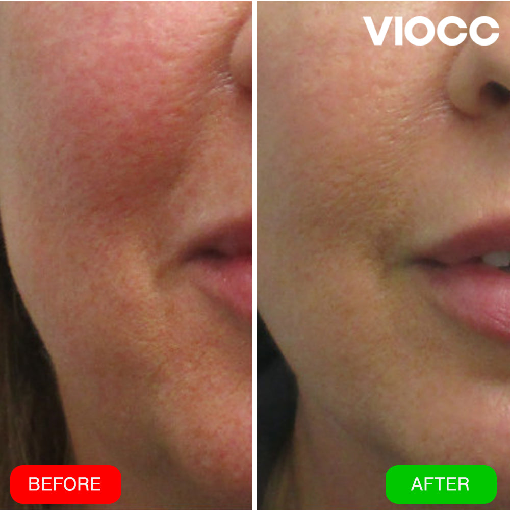 VIOCC™ OxyLuxe Dermal Infusion - Eczema