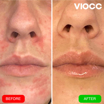 VIOCC™ OxyLuxe Dermal Infusion - Eczema